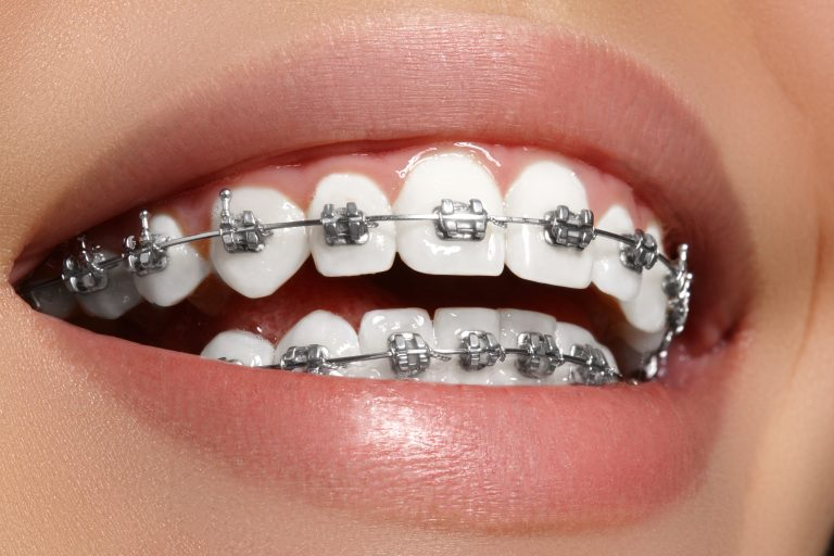 Orthodontic Treatment - Braces for Children and Adults
