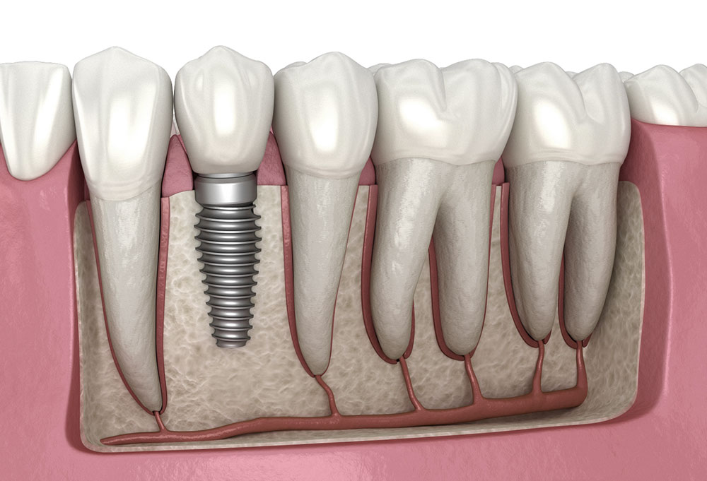 Permanent Dental Implants Surgery Bangalore